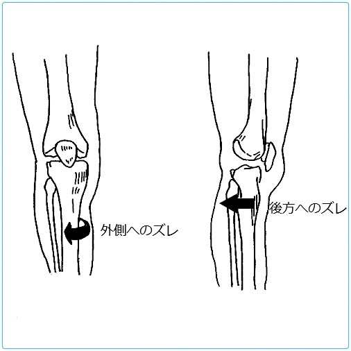 膝痛（ひざ痛）の図