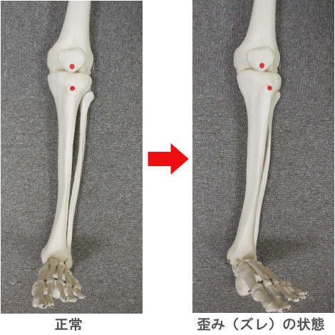 膝の骨のズレ方の図
